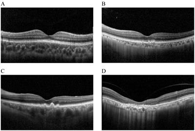 Dry age-related macular degeneration classification from optical coherence tomography images based on ensemble deep learning architecture